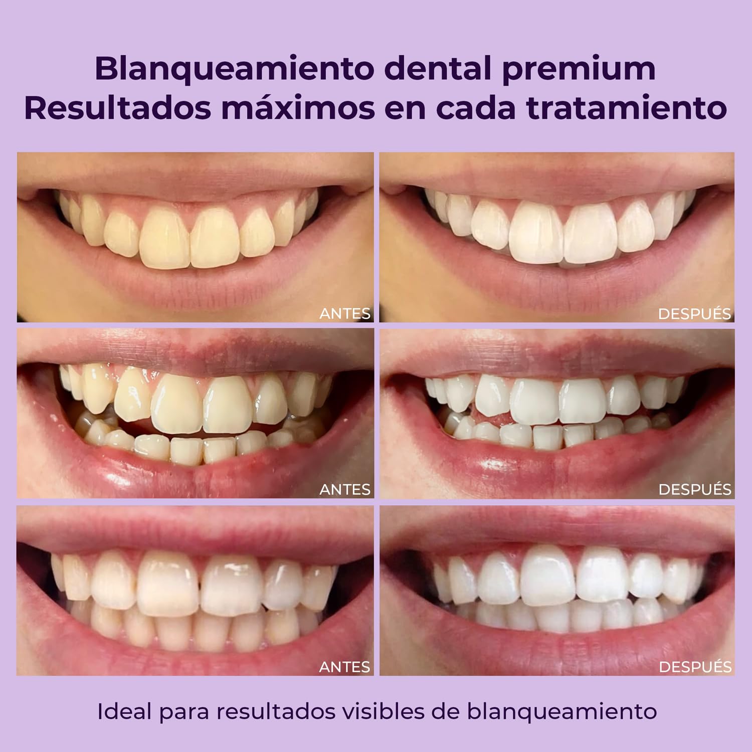 OnlySmile Kit Blanqueador Dental Profesional – Producto Favorito 2024-2025 – Blanqueamiento Dental en Casa con Gel y Luz LED – Dientes Blancos 9 Tonalidades en 5 Días – Teeth Whitening Kit, Vegan
