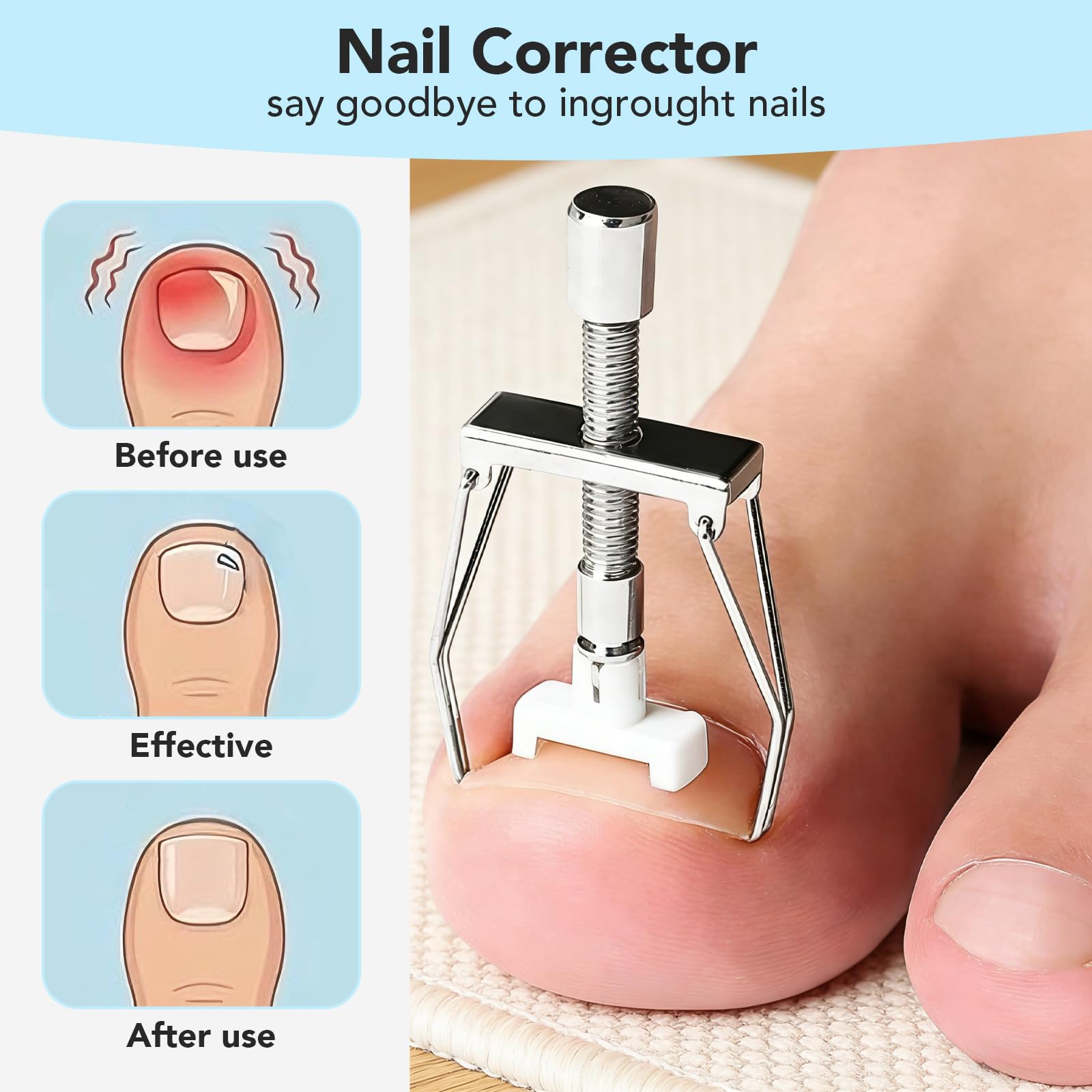 Juego de corrección de uñas encarnadas, juego de herramientas simple para uñas encarnadas, pinza para uñas de los pies con parche corrector de uñas, juego de cuidado profesional de los pies de