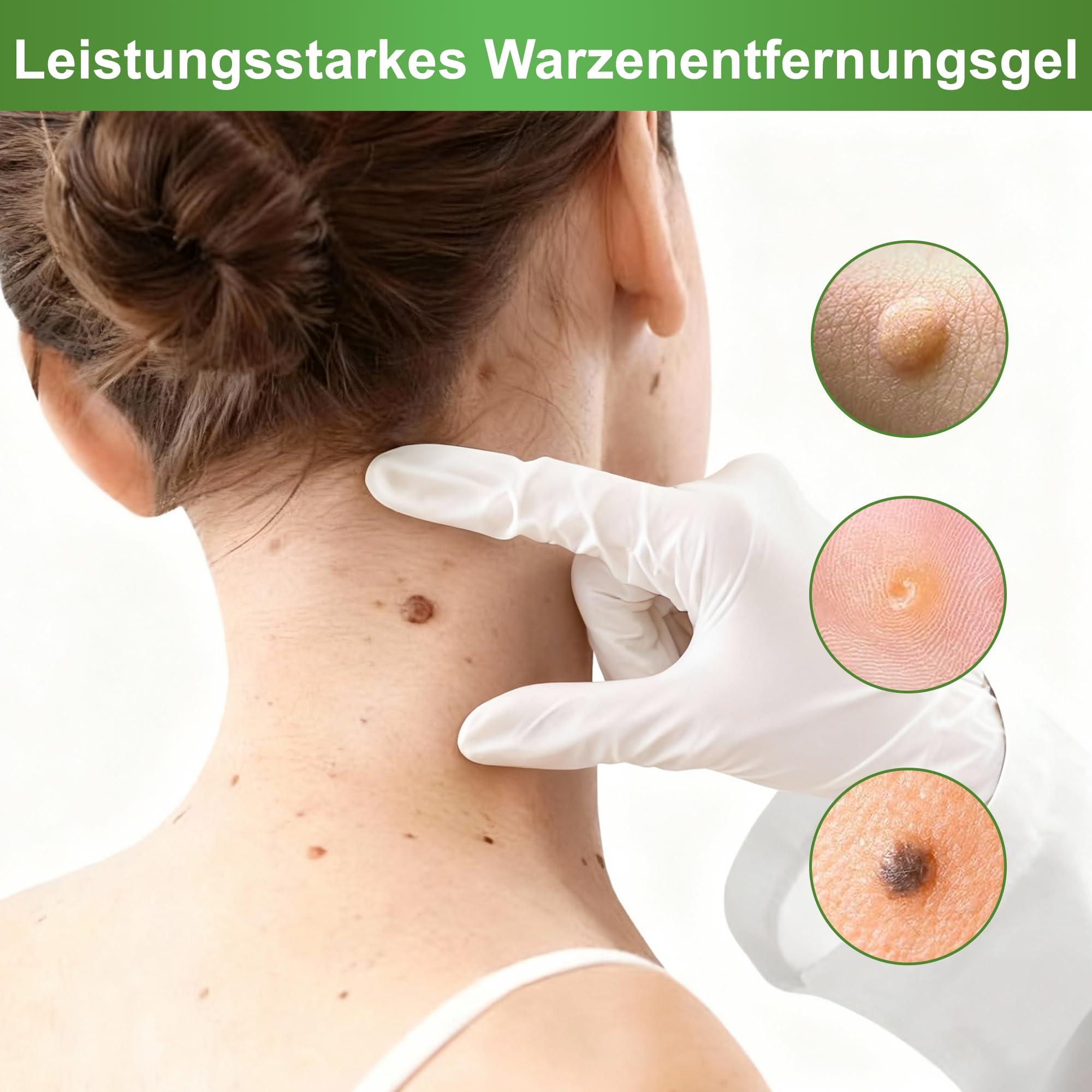 Warzenentfernercreme – geeignet für alle Hauttypen, Sanfte Formel für Körper und Hände (18G)
