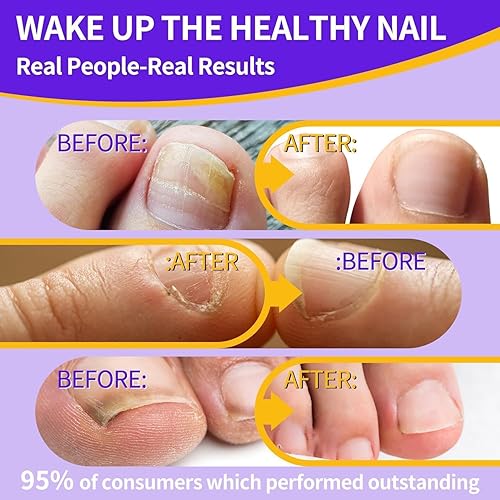 Miniatura 6 de Tratamiento de hongos en las uñas de los pies extra fuerte, tratamiento de hongos en las uñas del pie, tratamiento de hongos de hongos en las uñas,