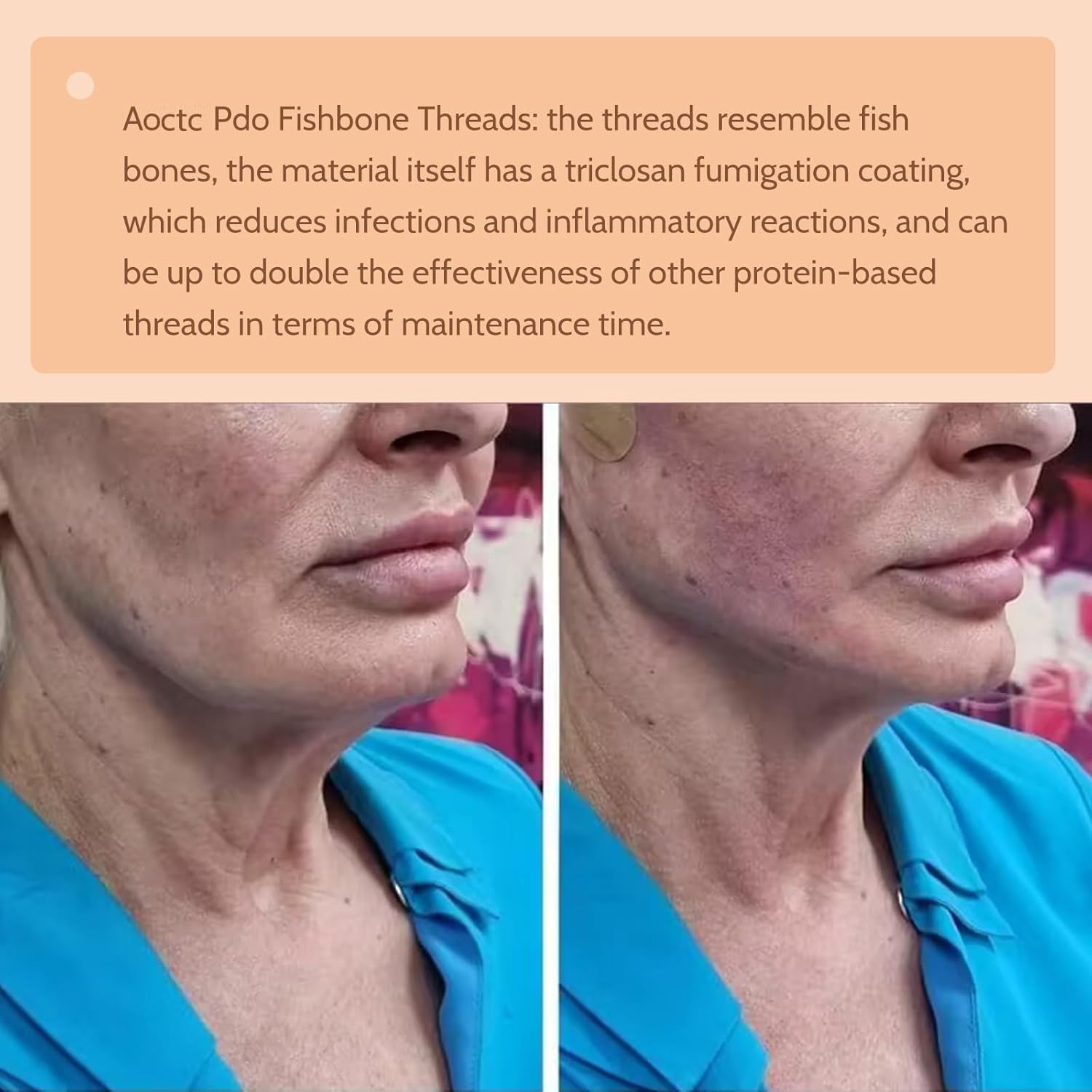Hilos PDO para Elevación Facial 18G100mm, Hilo de Espina de Pescado, 20 Unidades de Hilos de Engranaje, Producción de Colágeno, Tratamiento Antienvejecimiento, Reducción de Arrugas
