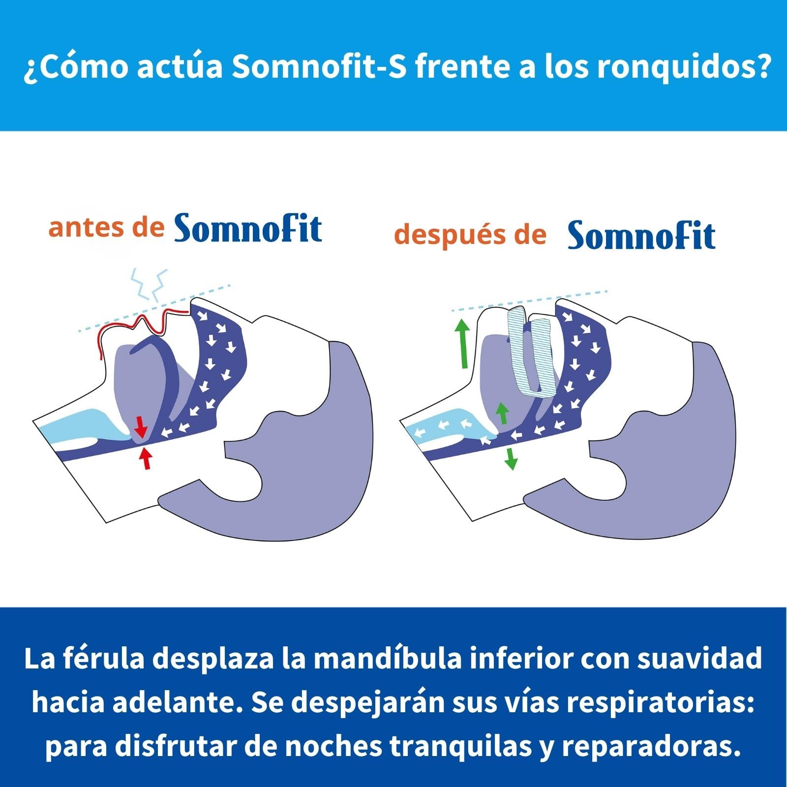 Somnofit Férula para ronquidos ayuda inmediata contra los ronquidos y la apnea del sueño - Calidad de Suiza - Adiós sofá: dormir juntos, empezar a trabajar con energía en la vida cotidiana