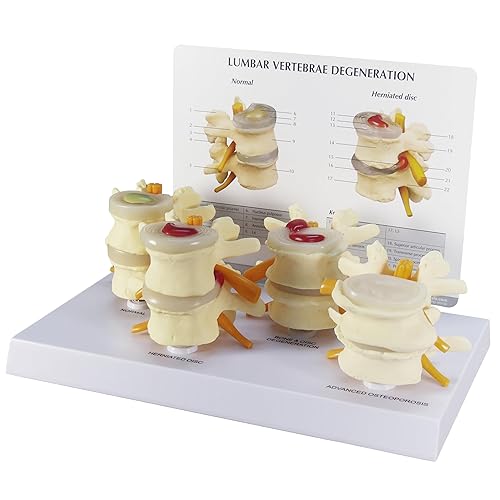 Miniatura 1 de Modelo de columna vertebral  Réplica de anatomía corporal humana de condiciones de vértebras de cuatro etapas para médicos herramienta educativa de