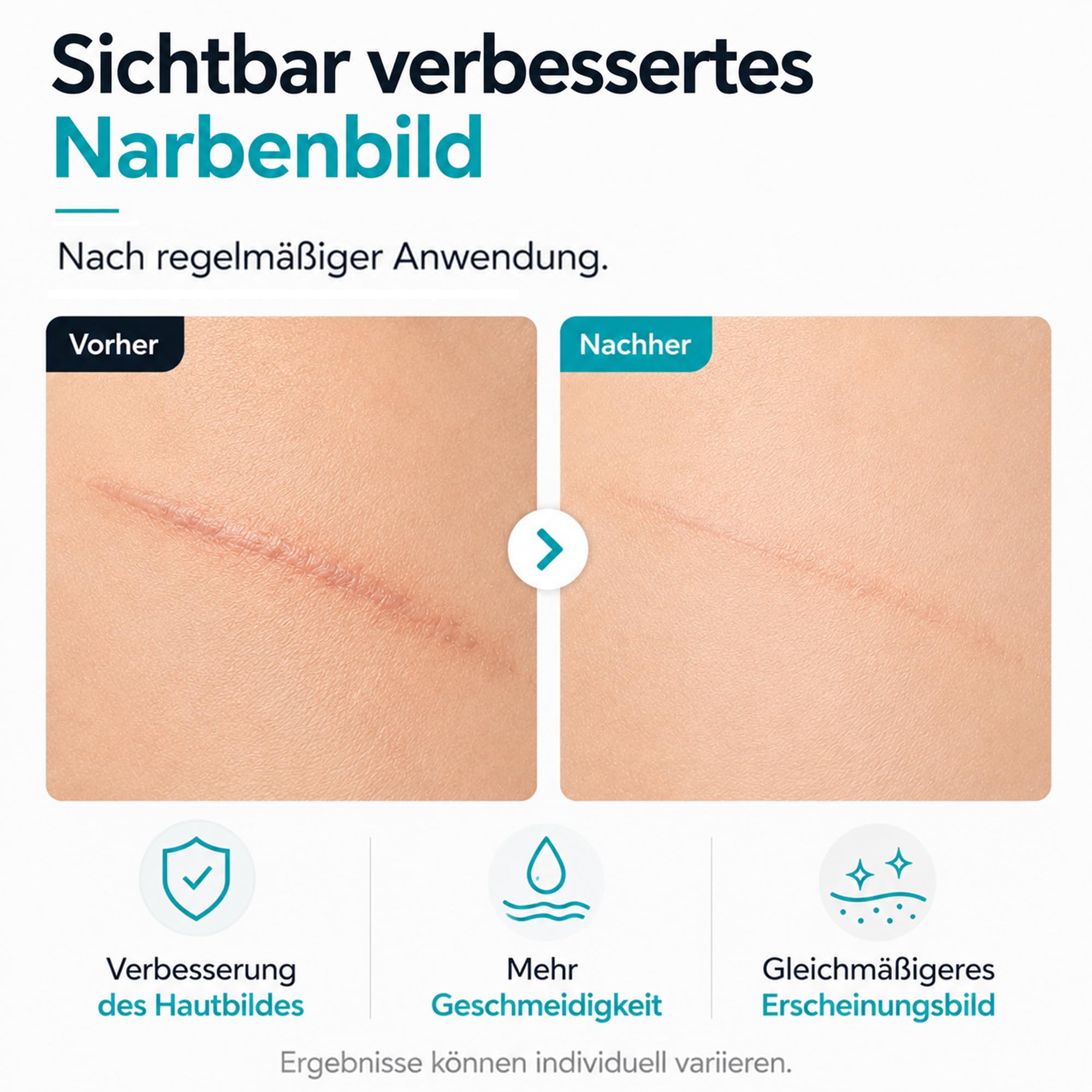 Krem do pielęgnacji blizn – regenerująca pielęgnacja świeżych i dojrzałych blizn | z madecassozydem, kwasem hialuronowym i ektoiną | do wszystkich rodzajów skóry | bez perfum, silikonów i