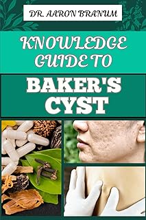 KNOWLEDGE GUIDE TO BAKER’S CYST: Essential Manual To Symptoms, Diagnosis, Treatment Options, And Prevention For Optimal Knee Health