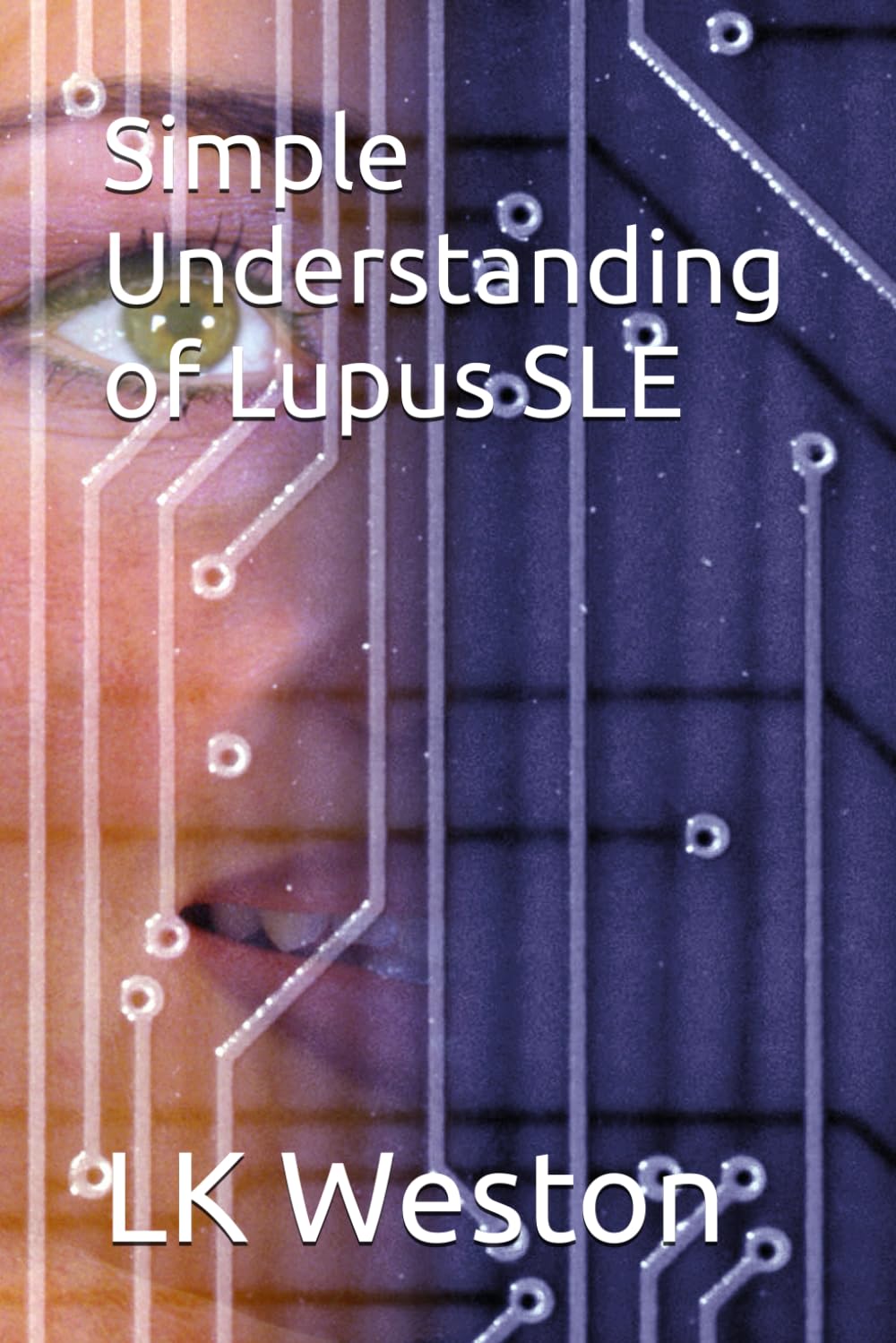 Simple Understanding of Lupus SLE