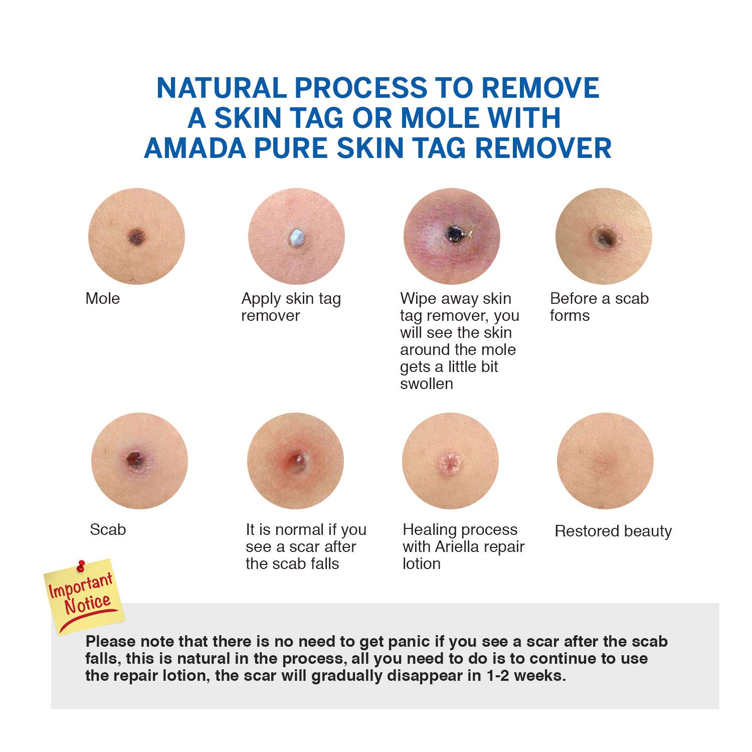 Amada Pure Mole Corrector & Skin Tag Remover and Repair Lotion Set, Remove Moles and Skin Tags Easy : Beauty & Personal Care