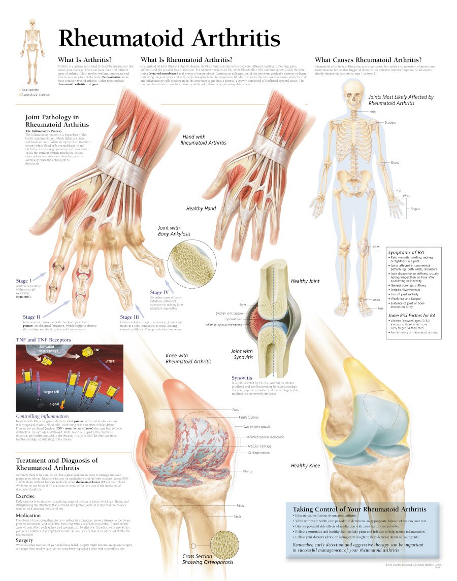 Snapklik.com : Rheumatoid Arthritis: Laminated Wall Chart