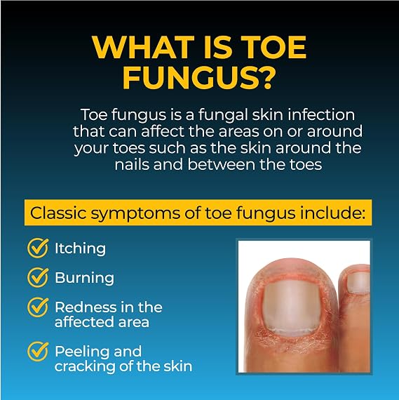 Fungi-Nail Anti-Fungal Liquid Solution, Kills Toe Fungus and Tolnaftate & Clincially Proven to Cure and Prevent Fungal Infections, 1 Oz (Pack of 1)