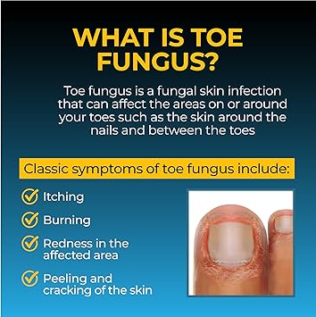 Fungi-Nail Anti-Fungal Liquid Solution, Kills Toe Fungus and Tolnaftate & Clincially Proven to Cure and Prevent Fungal Infections, 1 Oz (Pack of 1)