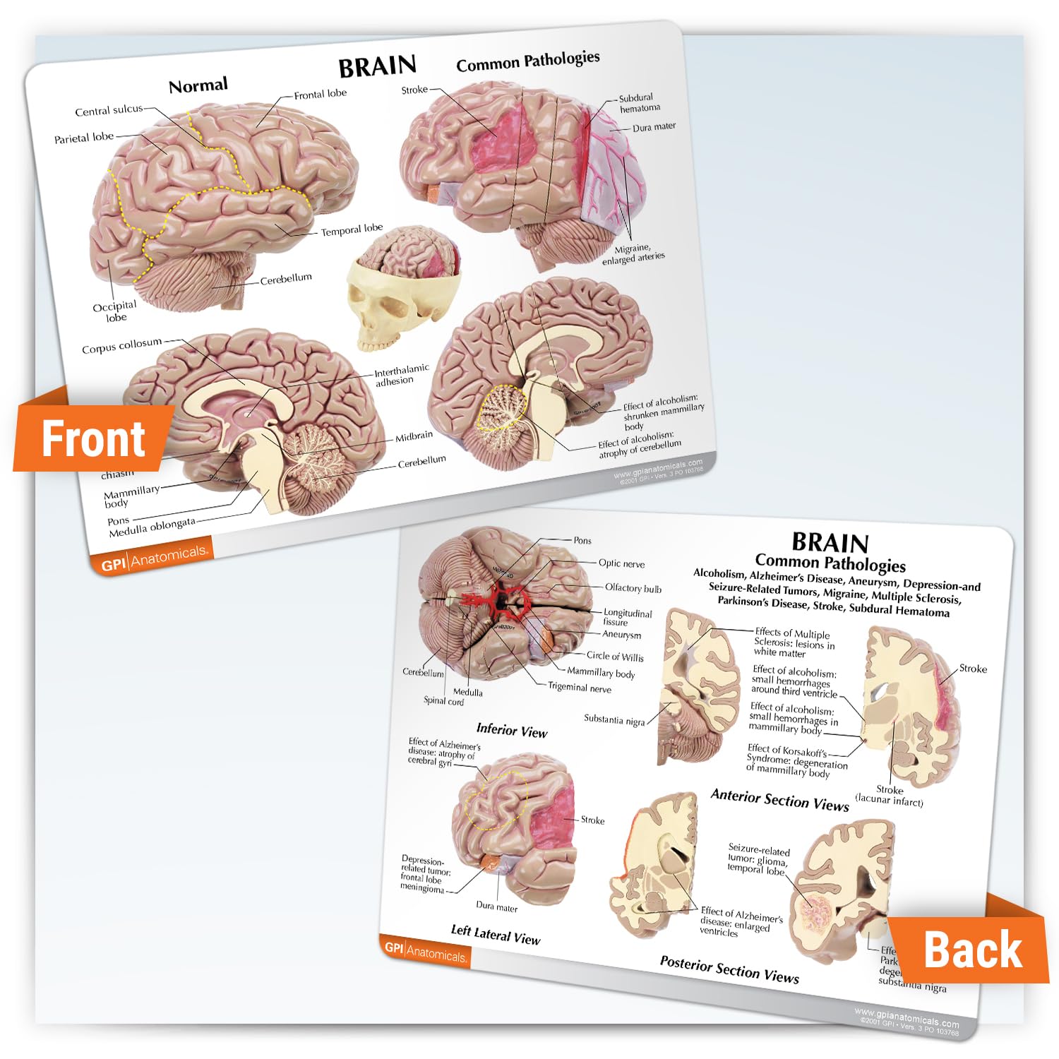 Amazon.co.jp: GPI Anatomicals - 脳モデル 人体解剖学のための病理学