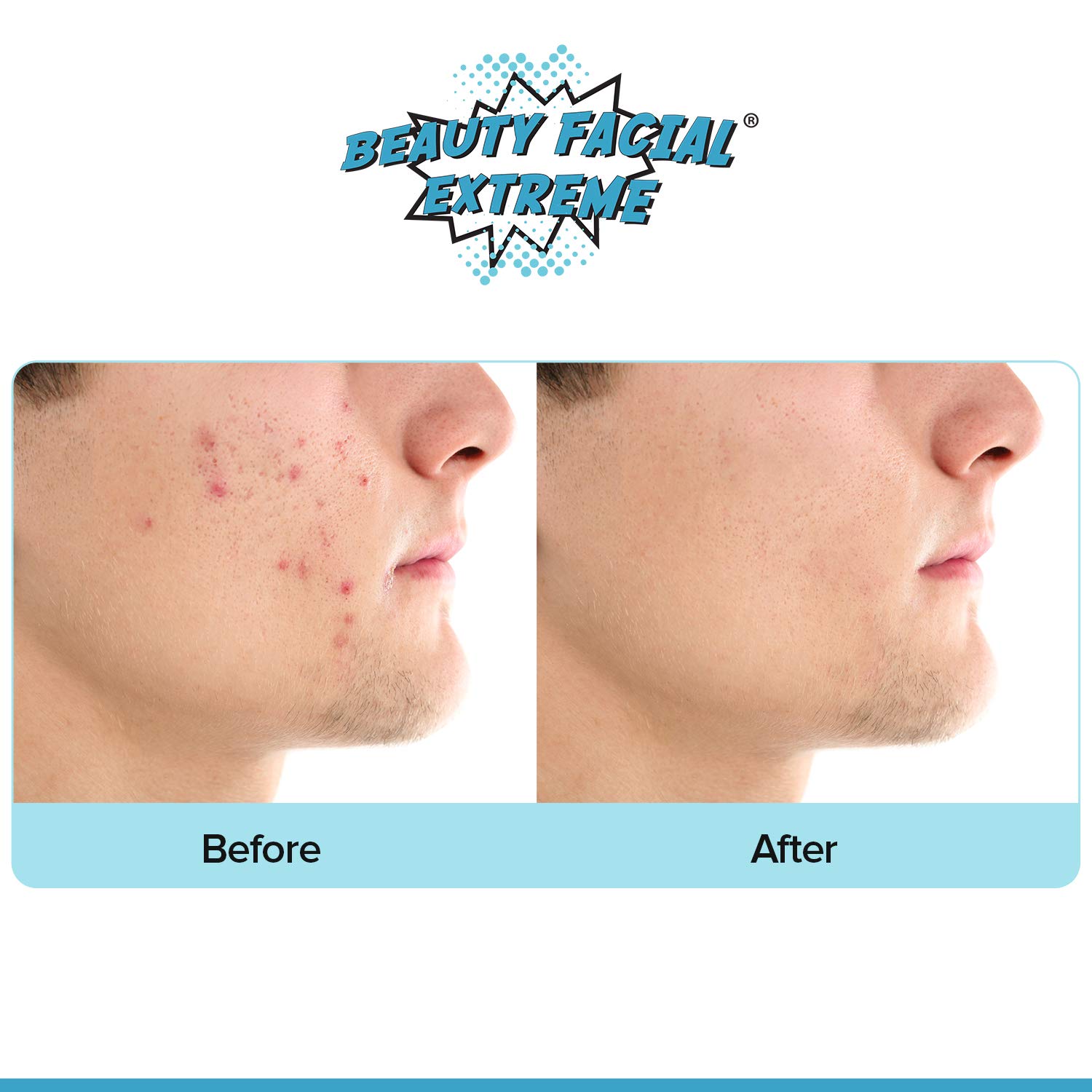 Acne Treatment Clay Mask Clears Away Clogged Pores, Blackhead