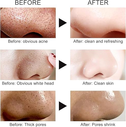 Miniatura 8 de Mascarilla removedor de puntos negros, mascarilla facial de carbón para limpieza profunda para cara, nariz, poros y acné, para todo tipo de piel,
