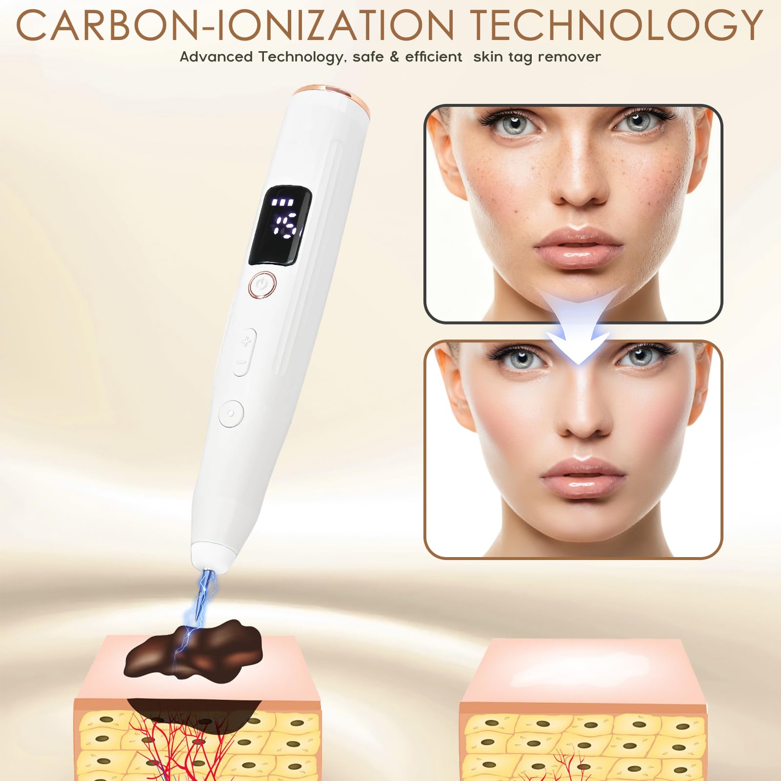 Sicura e Penna Al Plasma,Rimuove Voglie Verrucheskin Tag Remover con 15 Livelli Regolabili e Luce Led, Penna Al Plasma Ricaricabile Tramite Usb per Nei, Verruche, Lentiggini, Macchie Scure