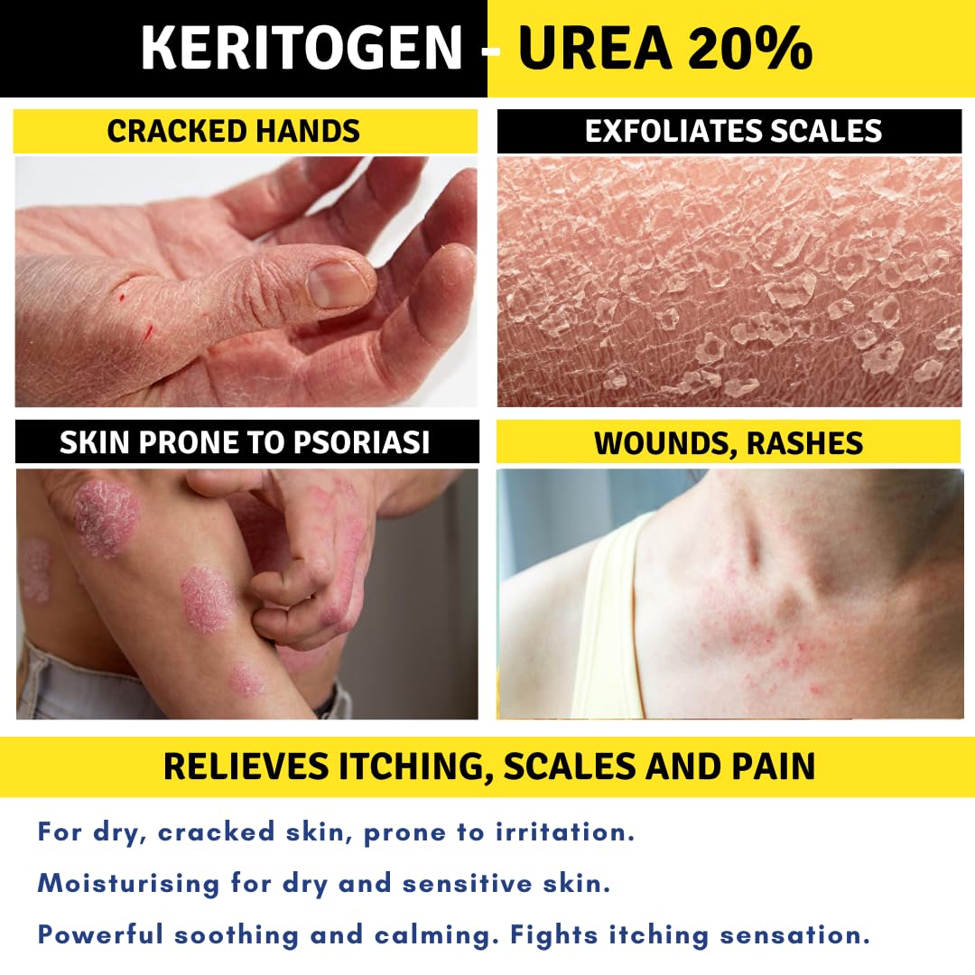 Crema Urea 20%, Eczemi, Cheratosi, Psoriasi, Eruzioni Cutanee, Riduce il Prurito, Sechezza, Pelle Secca e Screpolata, Calli, Duroni, Desquamazioni,- Cocos e Olio d'Oliva, 50g