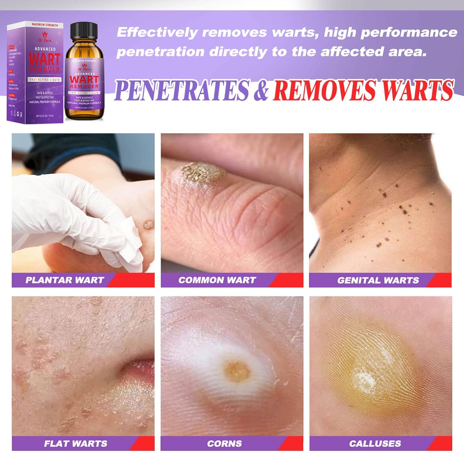 DR. DERM Wart Remover Maximum Strength - Wart Remover Fast Acting Liquid Gel - Plantar and Genital Wart Treatment, Wart & Corn Remover for Corn, Common Wart, Flat Wart, Natural and Safe - 0.5 Fl Oz : Health & Household