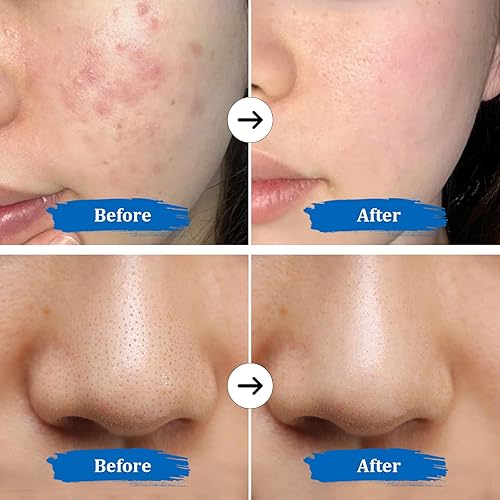 Miniatura 8 de GUGUG Exfoliante de piel 4 en 1 espátula facial impermeable para limpieza profunda, herramientas de eliminación de puntos negros, limpiador de poros