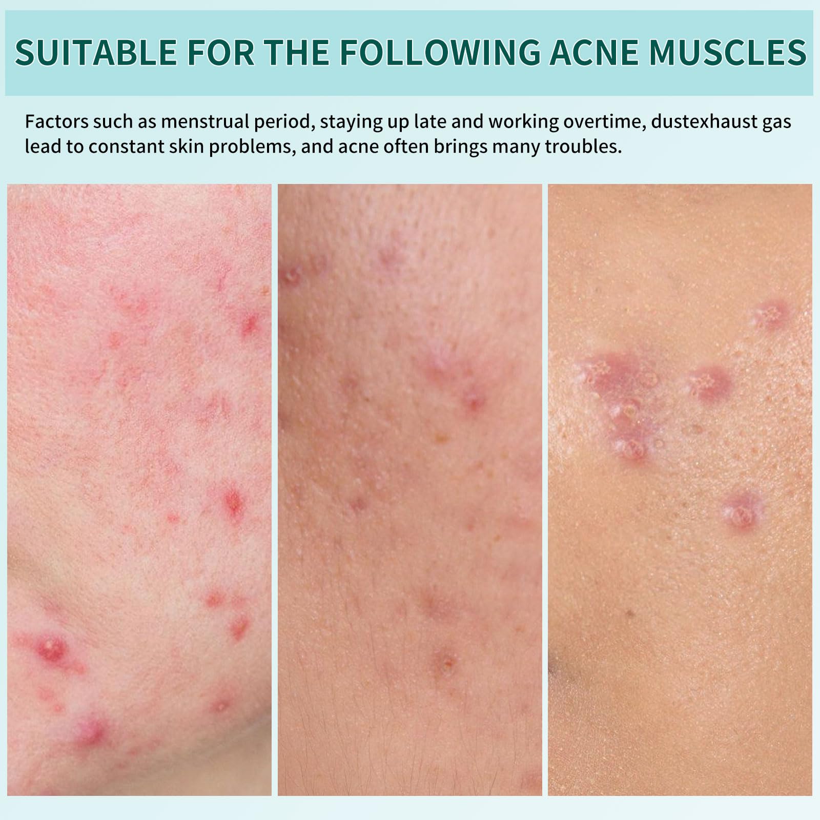 360 Pièces Patch Boutons Acne, 3 Tailles Pimple Patch Star Avec L'huile Tea Tree L'acide Salicylique, Invisibles et Hydrocolloïdes, Imperméables et Respirants, Patchs Étoile pour Jour et Nuit