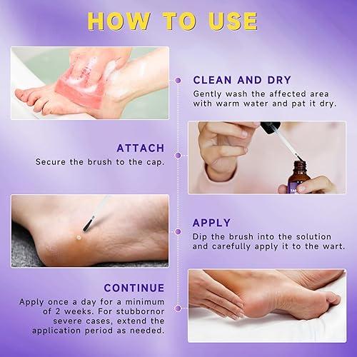 Miniatura 6 de TTsiya Eliminador de verrugas para congelar, removedor de marcas cutáneas de acción rápida con ácido salicílico, líquido para eliminar verrugas de