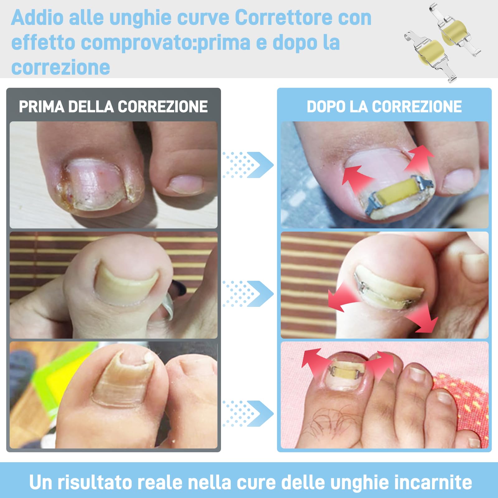 InhwRior Correttore per unghie incarnite, facile da usare a casa, stabile e sicuro, senza scivolamento, trazione continua per un sollievo rapido dal dolore, impermeabile per la doccia (19mm-21mm)