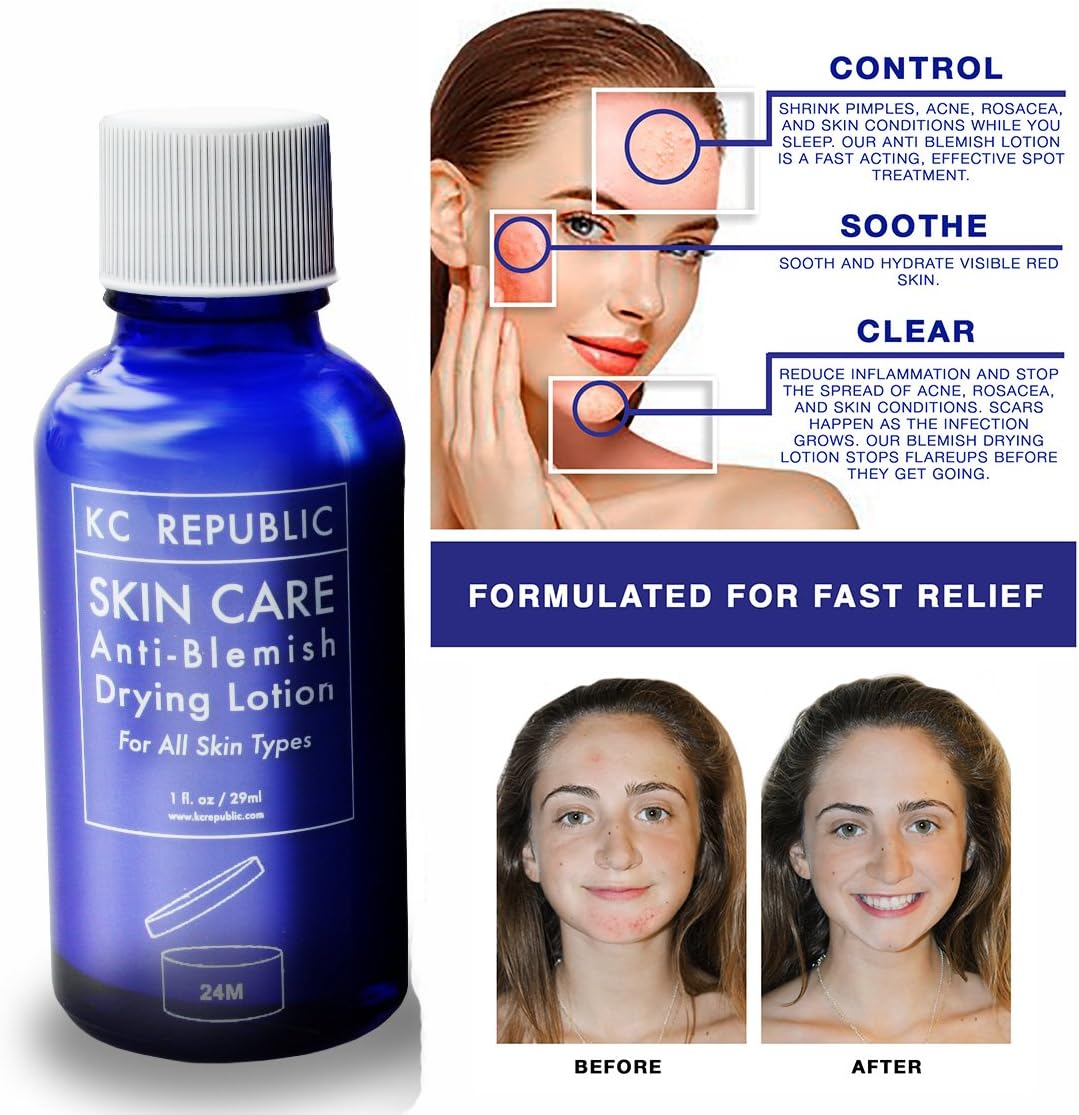 Acne Drying Lotion with Salicylic Acid & Calamine - Clears Pimples, Teen Acne, Rosacea, Blackheads and Blemishes - Bacteria Fighting Pimple Cream - Gentle Acne Treatment for all Skin Types, Men & Wome