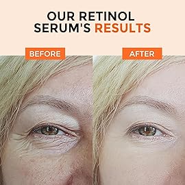 Retinol Serum for Face 2.5%, B5 Herbal Resurfacing Retinol with Vitamin C, Vitamin E, Hyaluronic Acid, Anti-Aging, Wrinkle Smoothing, Dark Spot Corrector, Brighten Dullness 2 Packs