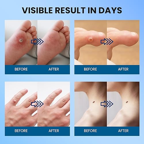 Miniatura 3 de Almohadillas eliminadoras de verrugas plantares Bandaid removedor de verrugas de ácido salicílico para verrugas plantares, verrugas de manos,
