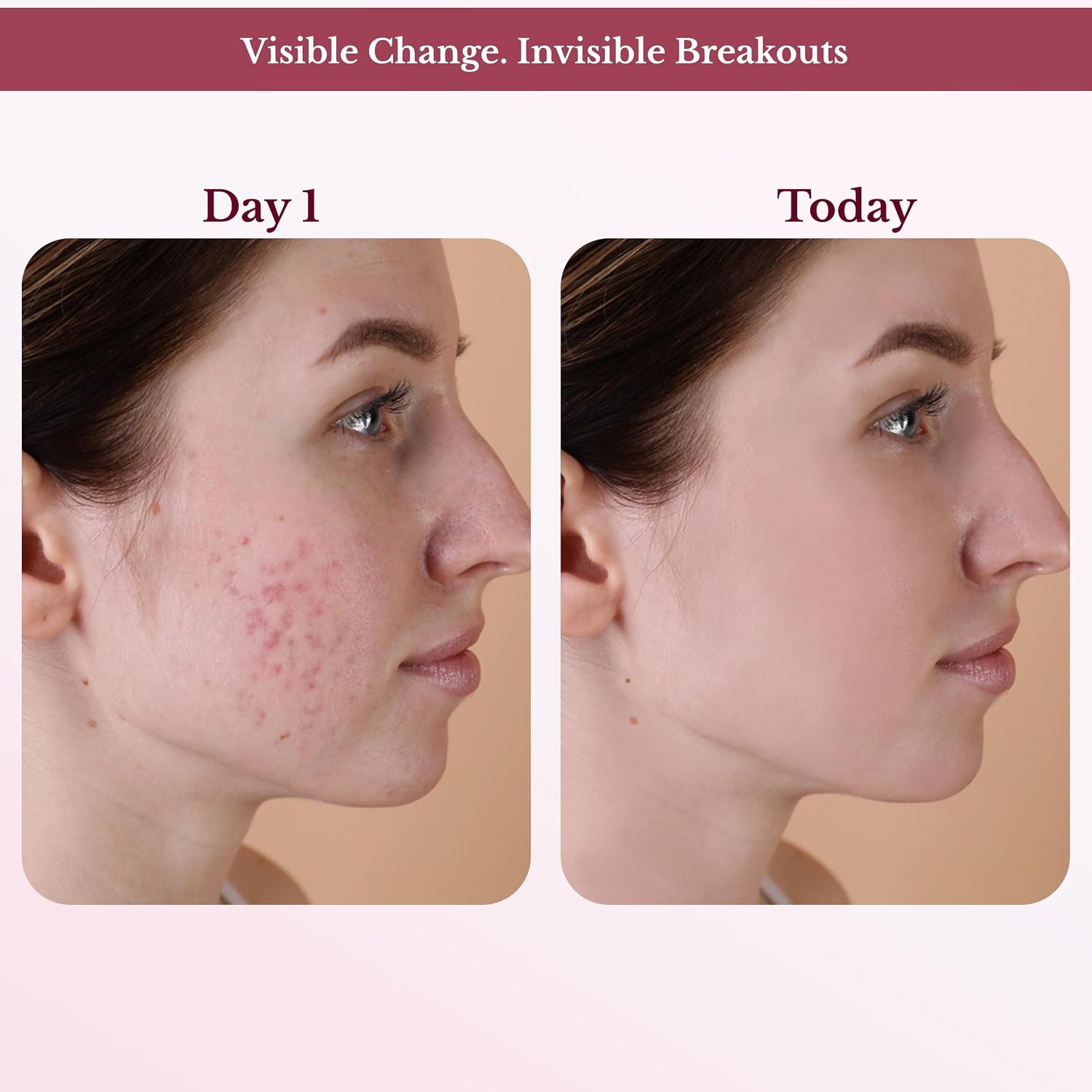 ACNE CLEANSER (4oz) Blemish Astringent Skin Care Oily Clogged Pores Blackheads Pimples Face Cleaner