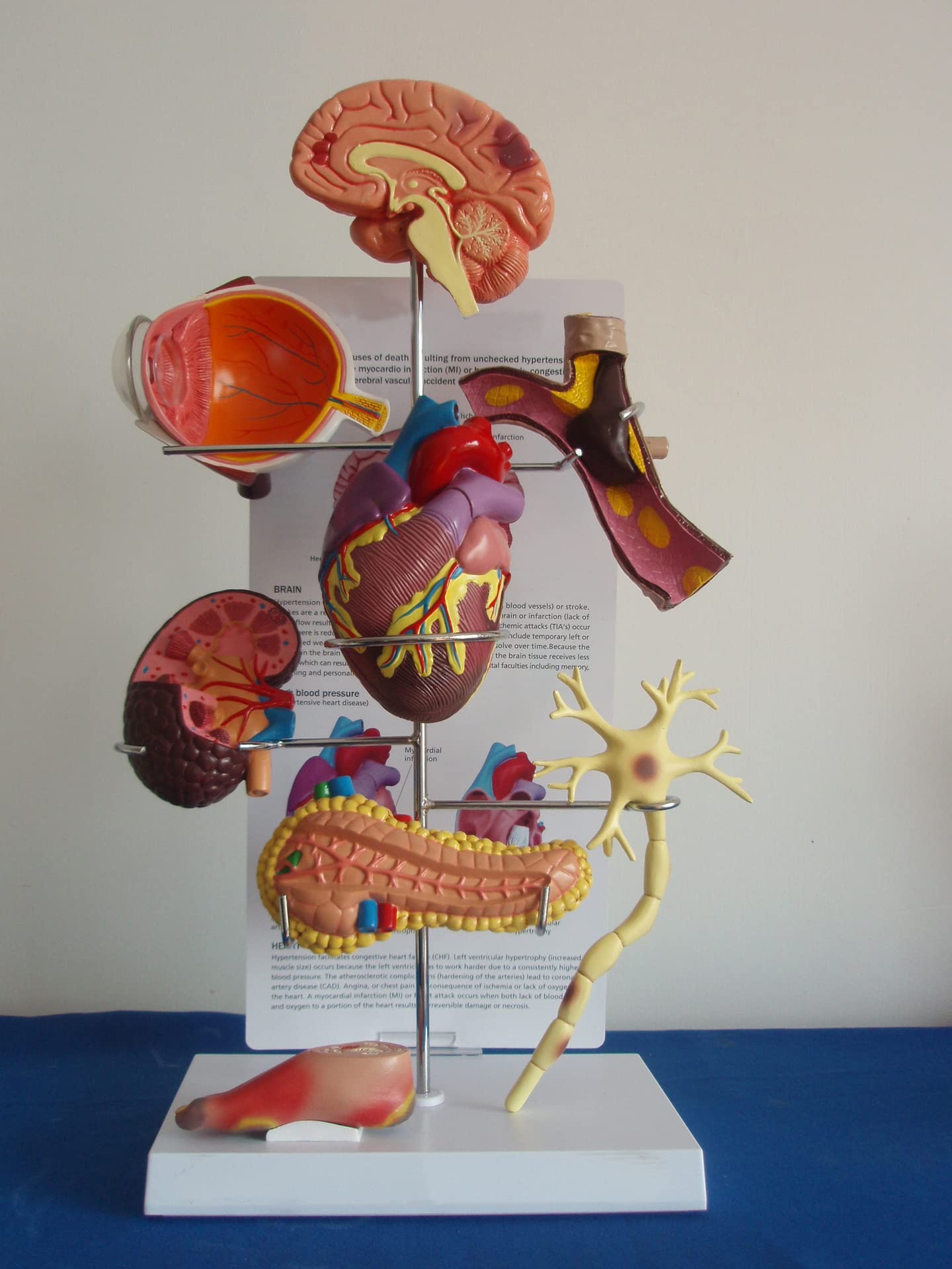 Modèle De Diabète Modèle Visuel Modèle D'hypertension Modèle De Diabète Cerveau, Oeil, Coeur Huit Organes