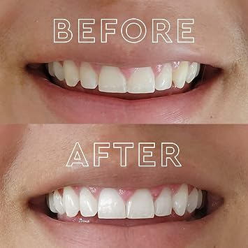 MOON Teeth Whitening Kit, LED Light Teeth Whitener Device, 56 White Strips, USB Charger & Travel Case, Blue Light Whitening Tray Removes Stains & Whitens Up to 12 Shades in 2 Weeks (4 Piece Kit)