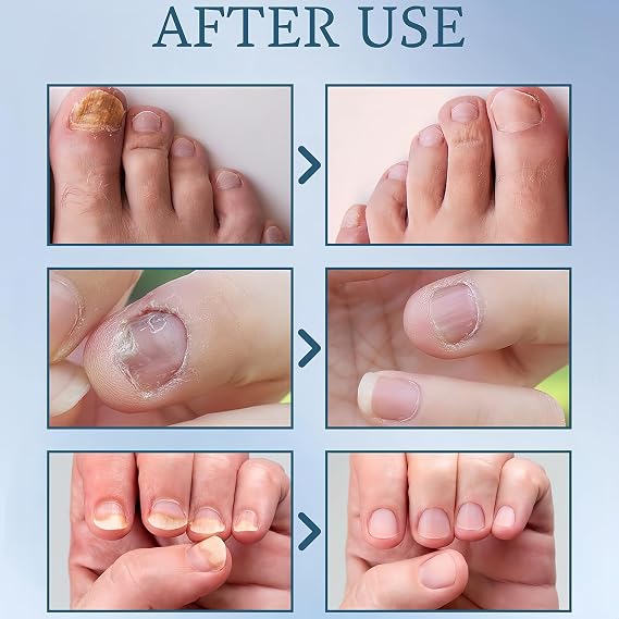 Maximum Strength Nail Fungus Treatment Liquid for Athletes Foot, Restores Thick, Broken, Discolored & Damaged Nails, Natural Appearance Restoration - 30ml