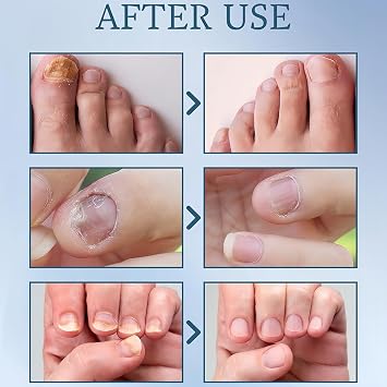 Maximum Strength Nail Fungus Treatment Liquid for Athletes Foot, Restores Thick, Broken, Discolored & Damaged Nails, Natural Appearance Restoration - 30ml