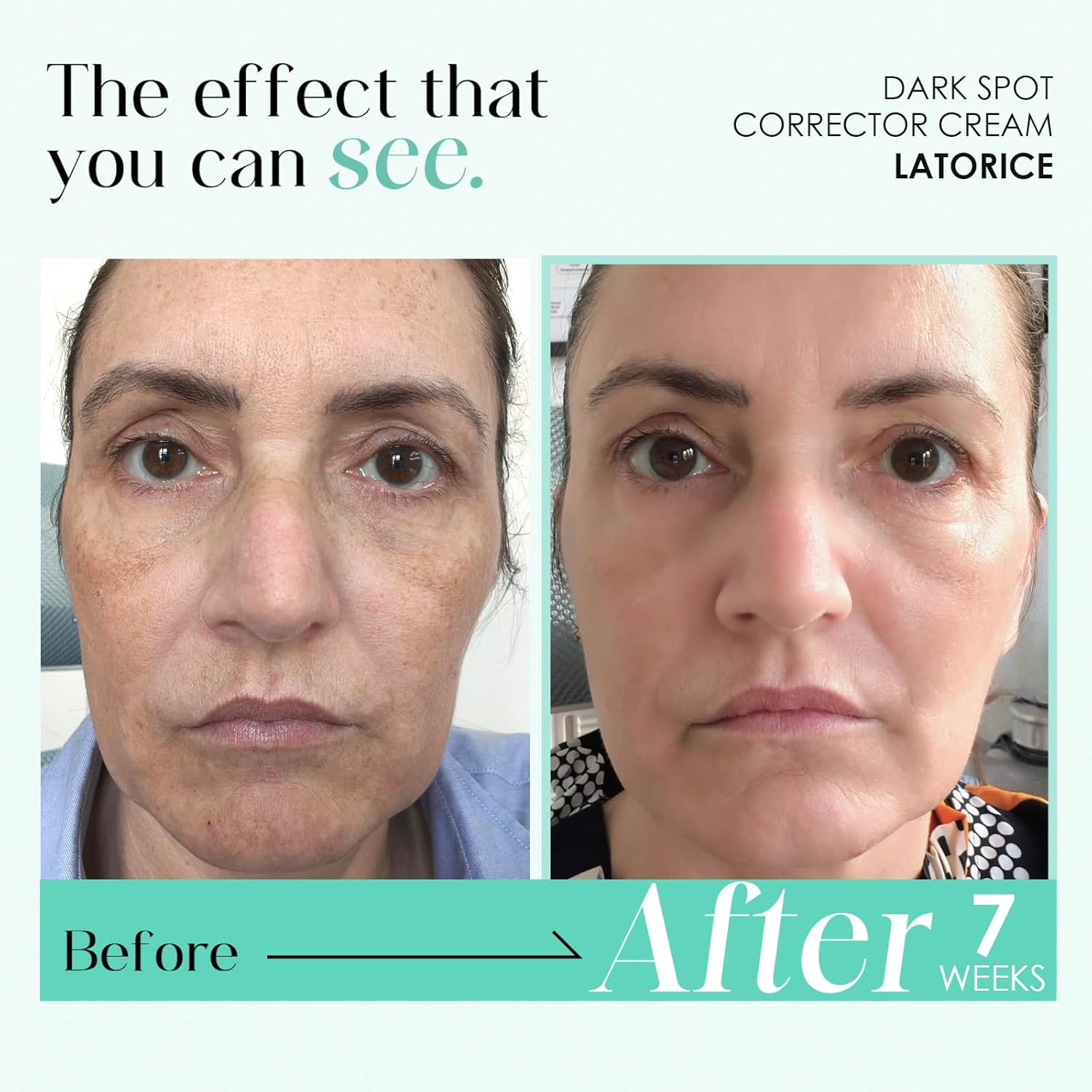 Dark Spot Remover for Face and Body: Tranexamic Acid Serum for Women and Men - Reduce Sun Spot Melasma Freckles - Natural Ingredient Enriching Skin Care (1.7 Fl Oz) - Image 3