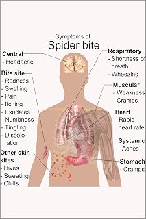 24"x36" Gallery Poster, Symptoms of Spider bite