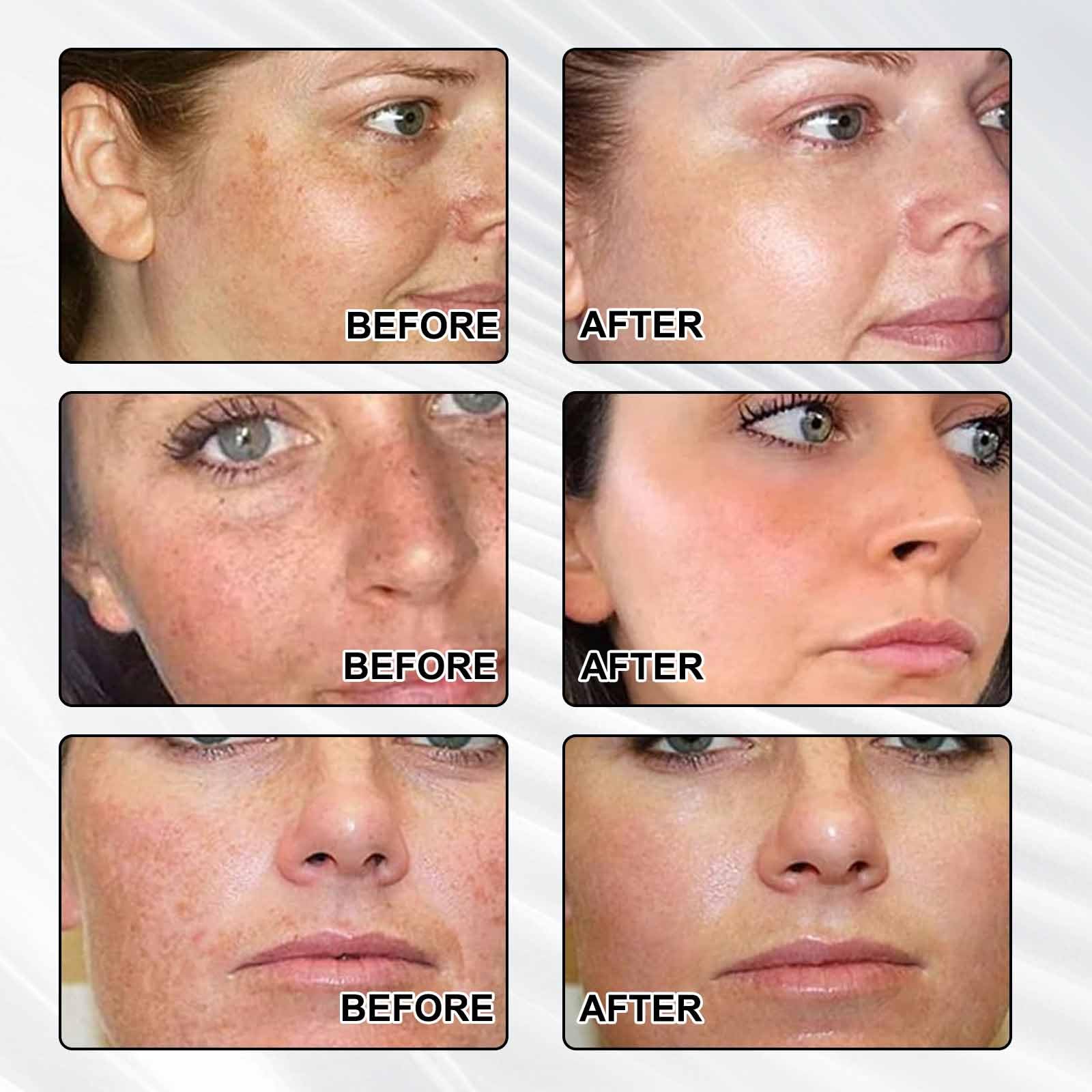 Dark Spot Remover for Face,-Age Spot Remover -Hyperpigmentation Treatment-Sun Spots and Melasma Treatment Cream for Face Pigmentation Freckle Removal Cream - Image 3