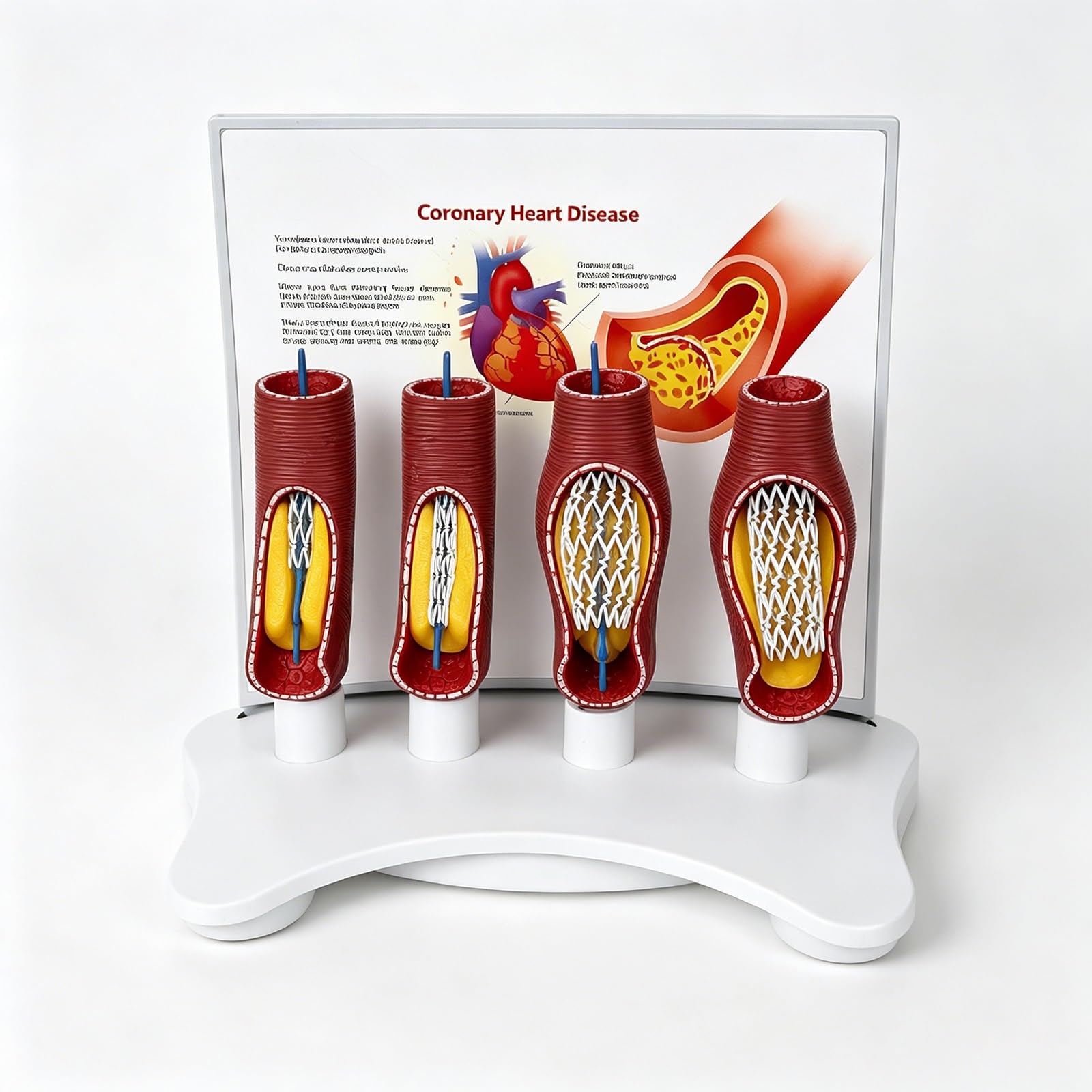 TQPGJJL Human Vascular Stent Model for Medical Teaching – Enlarged Coronary Artery Anatomy with Blockage Demonstration, PVC Anatomical Model for Cardiology Education and Training