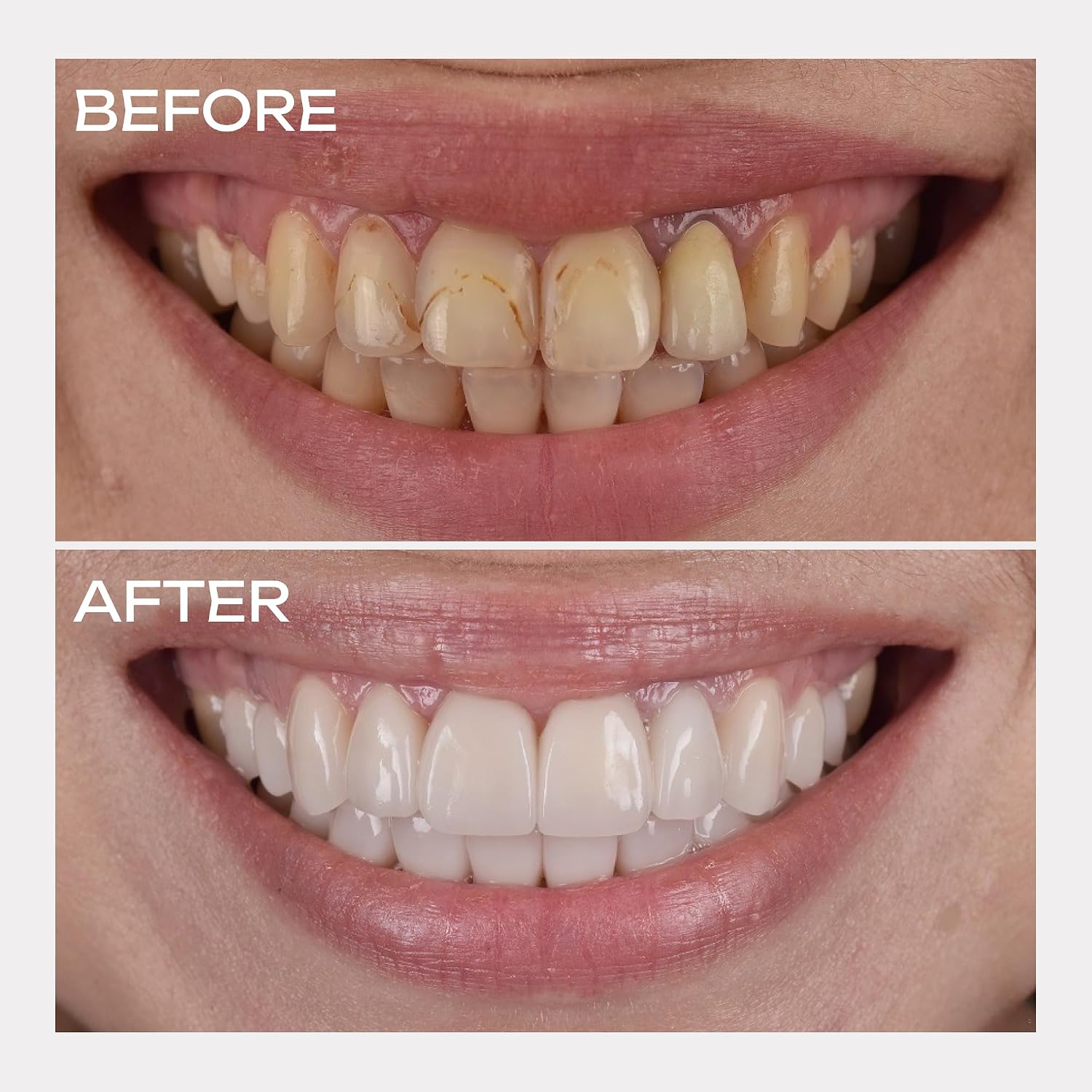 Purple Color-Correcting Teeth Whitening Foam, 50ml, Advanced Gentle Brightening and Stain-Removing Formula for Daily Use, Fresh Minty Flavor, Ideal for Sensitive Smiles