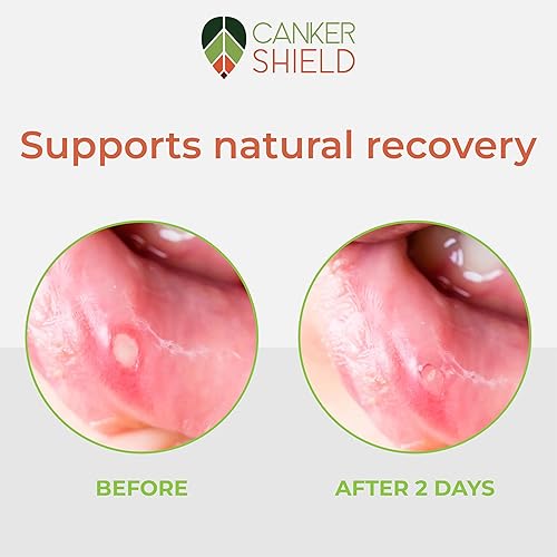 Miniatura 3 de Polvo natural para alivio de úlceras bucales y úlceras bucales - Polvo oral calmante para una comodidad bucal dirigida