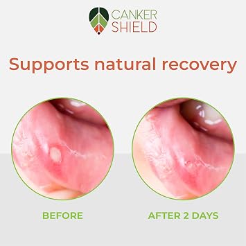 Natural Canker Sore & Mouth Ulcer Relief Powder Soothing Oral Powder for Targeted Mouth Comfort