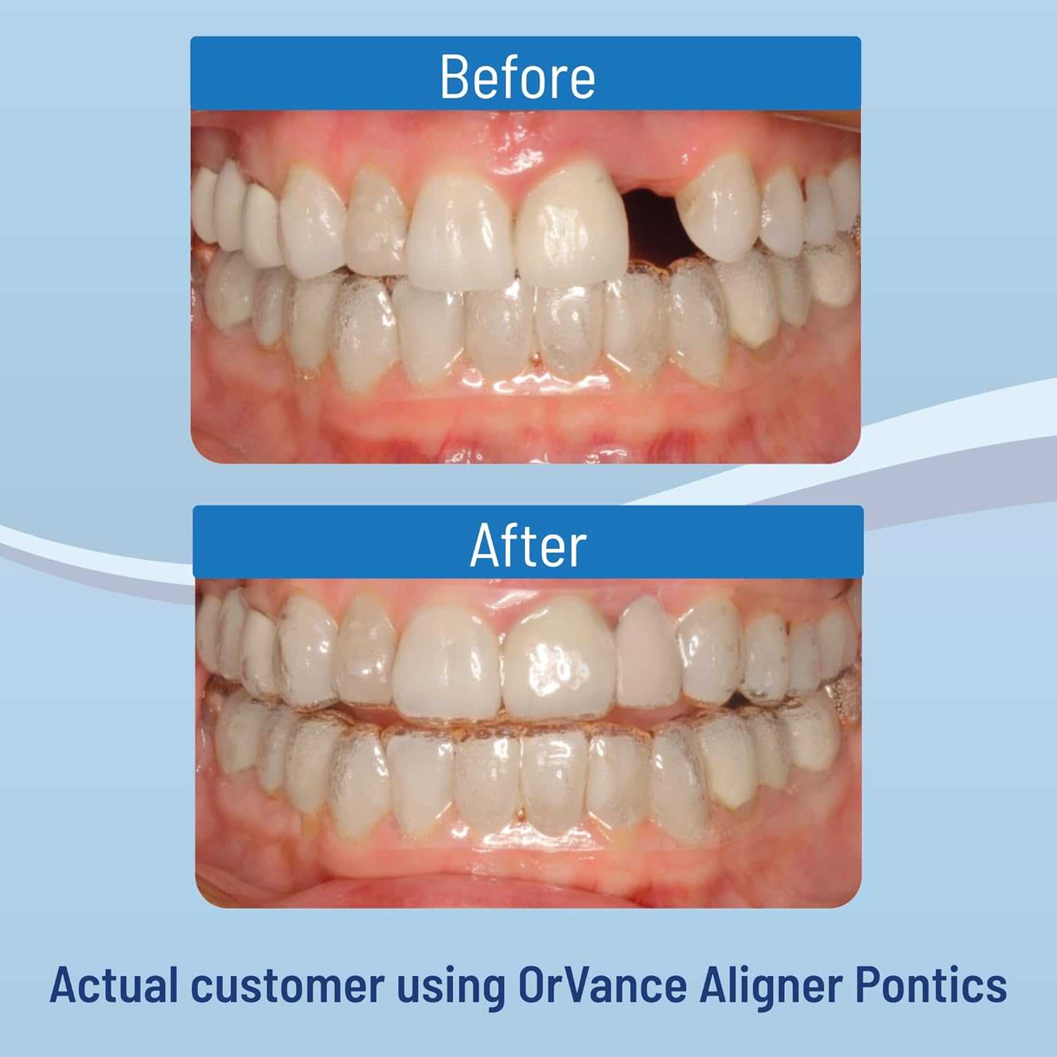 ORVANCE Aligner Pontics - Original (Medium) Shade (32 Count) | Temporary Tooth Replacement for Invisalign, Aligner Trays and Clear Retainers During Orthodontic Treatment
