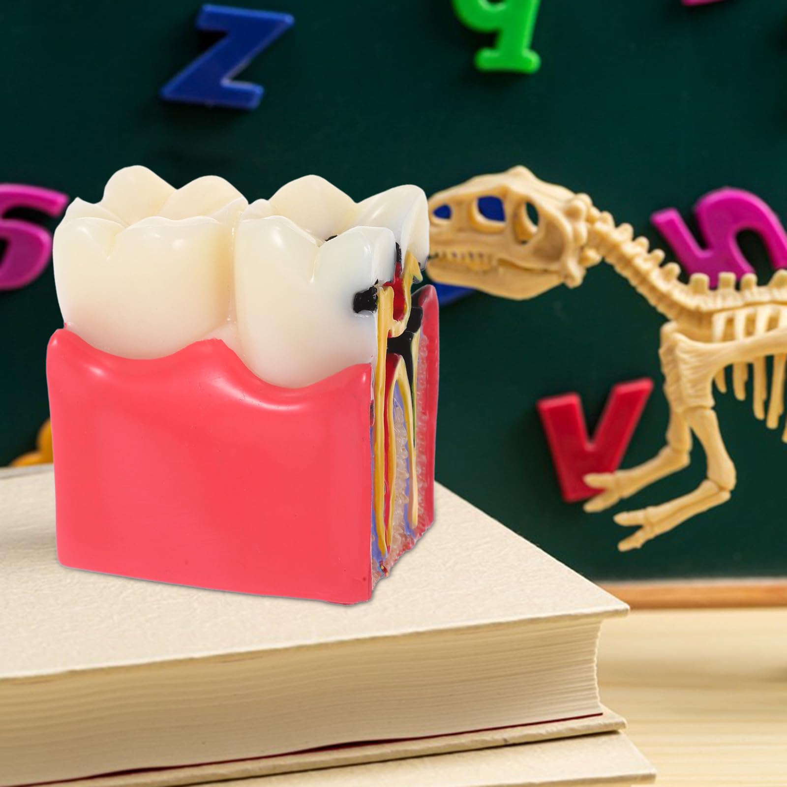 BESTYASH Modèle Pédagogique de Caries Dentaires à 6x Grossissement en Résine, Outil Typodont D'anatomie Comparée Dents Saines Vs Cariées, pour Enseignement en École et Cabinet