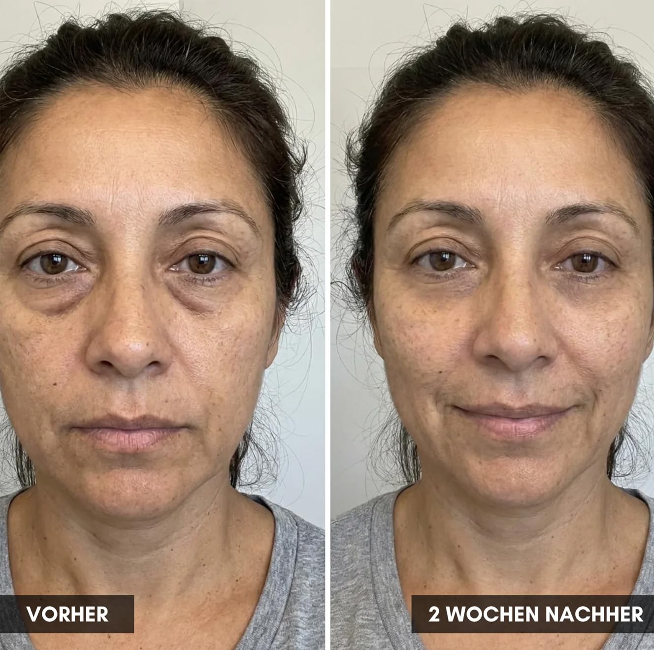 Invisla Lumin Eye, 2-in-1 Technologie Gegen Tränensäcke, Augenringe