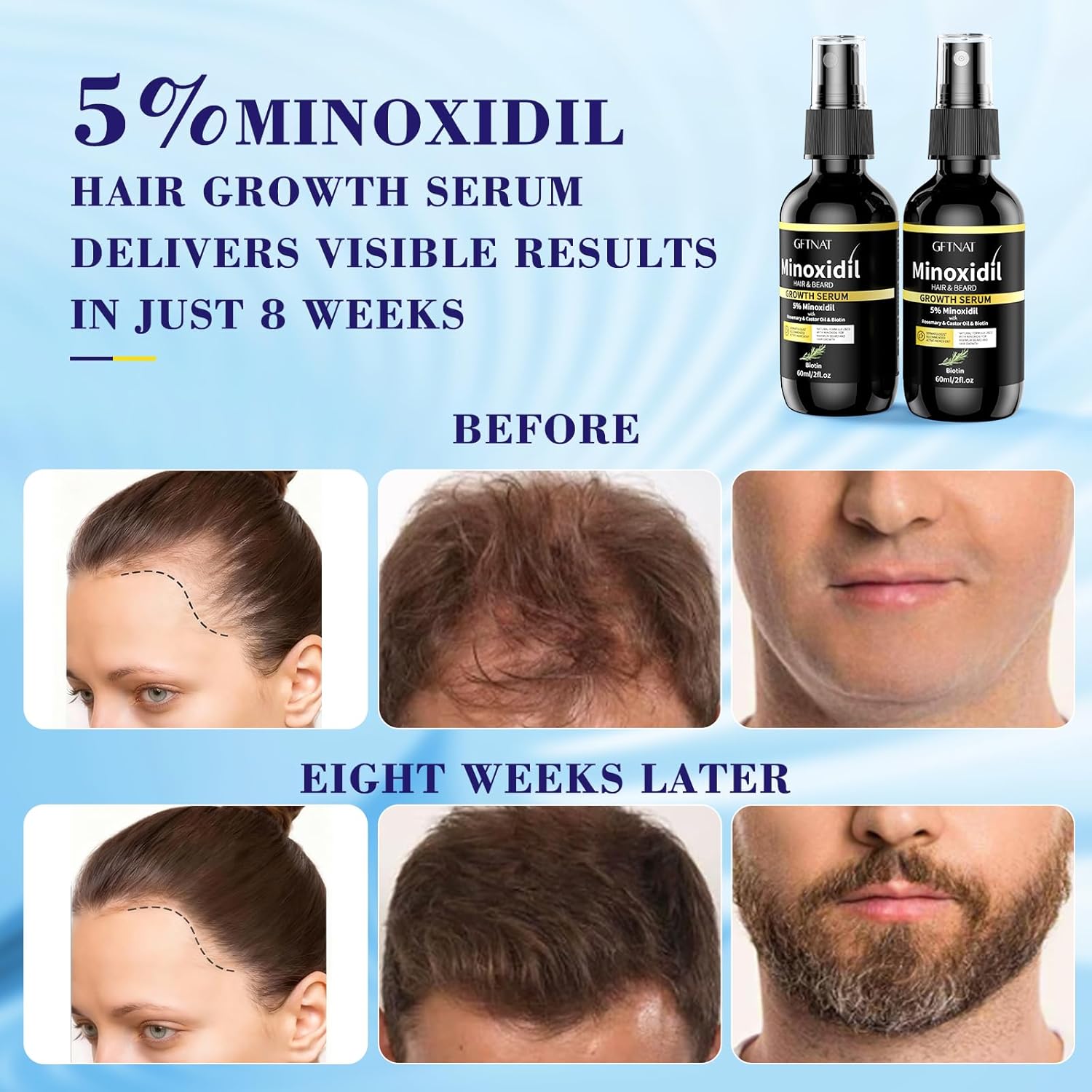 5% Minoxidil Spray for Men and Women Hair Loss Solution with Biotin and Rosemary Hair Growth Serum (Glass Bottle), Extra Strength 5 Percent Minoxidil for Thicker Fuller Hair Regrowth Treatments - Image 4