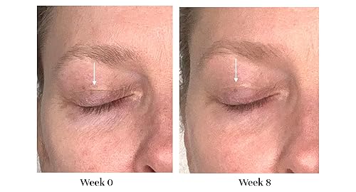 Miniatura 3 de City Beauty Tratamiento de elevación de la tapa, solución para párpados caídos, levanta, suaviza y aprieta, solución para flacidez y arrugas,