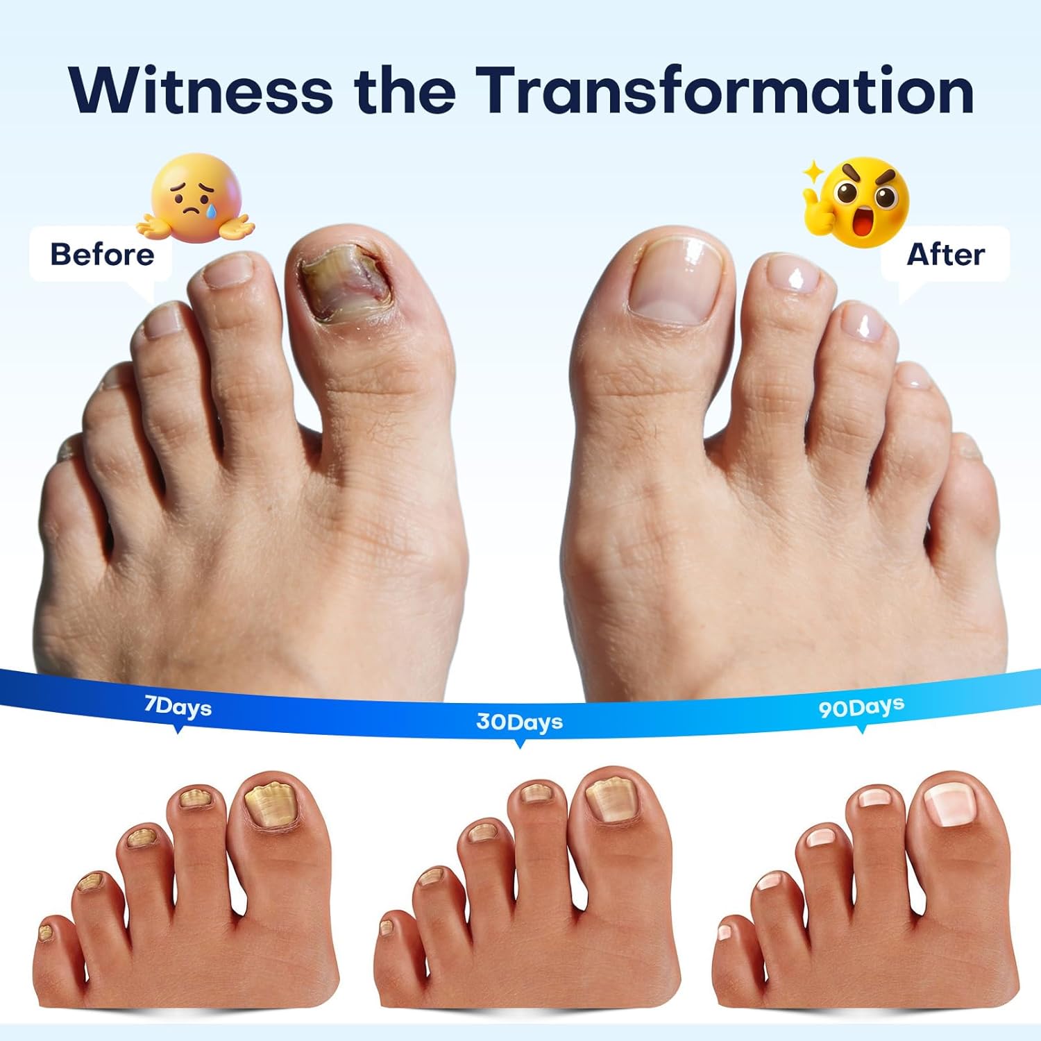 Villsure Toenail Fungus Pen - Toenail Fungus Treatment Extra Strength, Contains 25% Undecenoic Acid, Tea Tree Oils, along with Other Natural Ingredients, Mild and Non-Irritating- Nail Fungus Pen 5pcs - Image 4