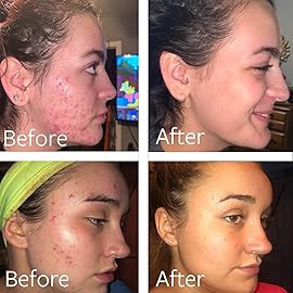 Dr Song Benzoyl Peroxide Wash 10% Acne Treatment: Acne Face Wash & Body Wash (8 Fl Oz (Pack of 1))