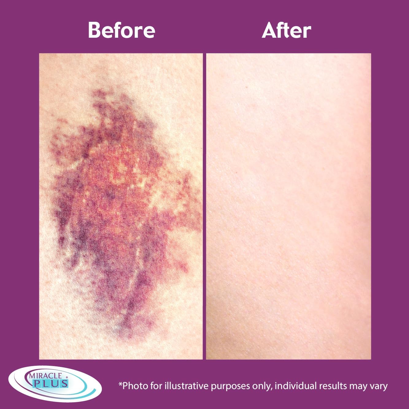 Miracle Plus Arnica Bruise Relief Skincare