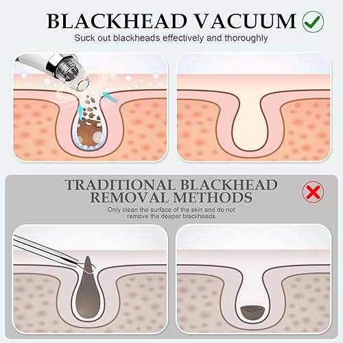 Miniatura 5 de Aspiradora facial para eliminar puntos negros, limpiador de poros y extractor de puntos negros con 3 niveles de succión ajustables, 5 sondas, kit de