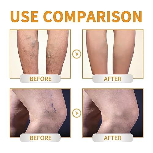 Miniatura 2 de EXQST Crema de vitamina K, crema milagrosa de la vena varicosa,Tratamiento de venas varicosas para piernas,Crema de tratamiento de venas