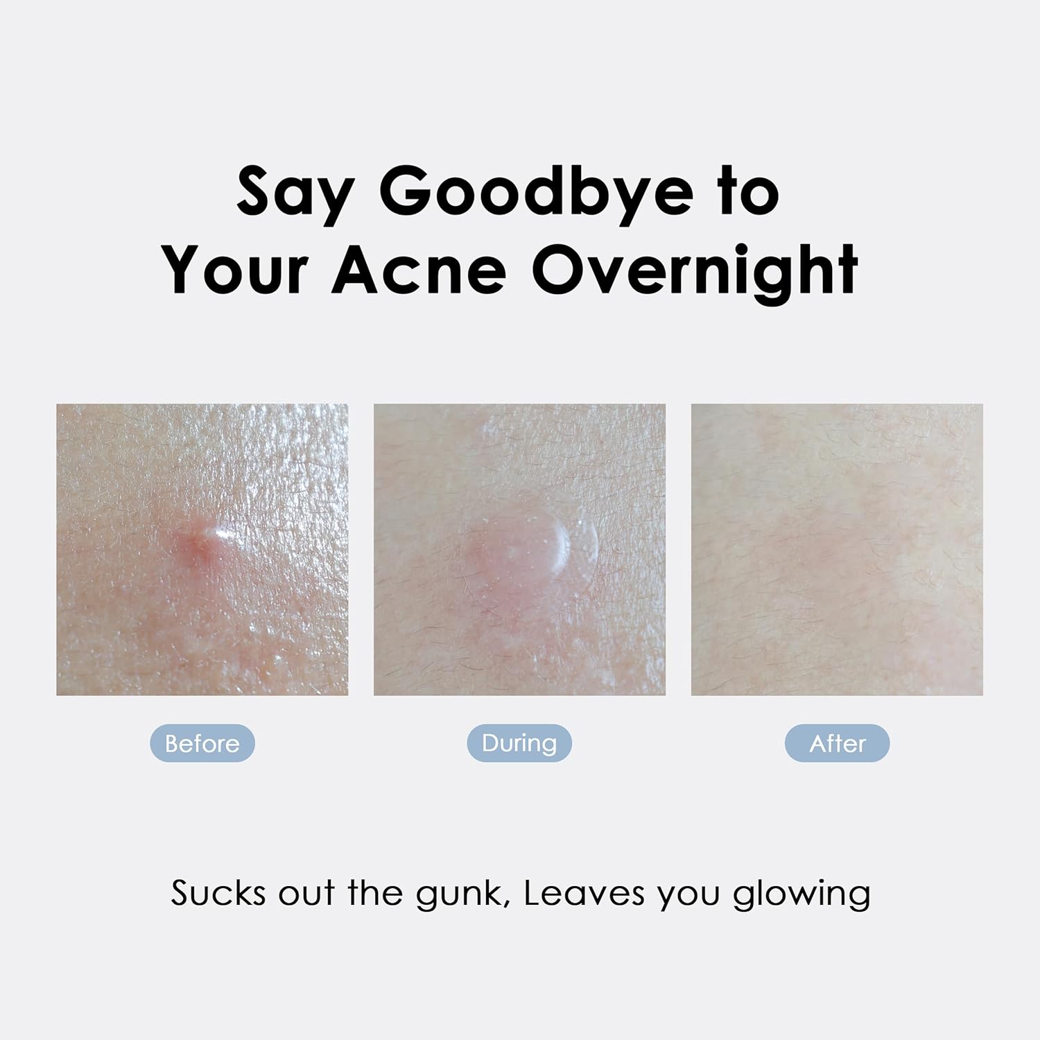 glowiest ASAP Active Spot Alleviating Patch [Bedtime] 52 Patches 8mm (16ea), 10mm (20ea) & 12mm (16ea) | Premium Hydrocolloid Dressing | Simple & Easy Active Treatment (Pack of 2)